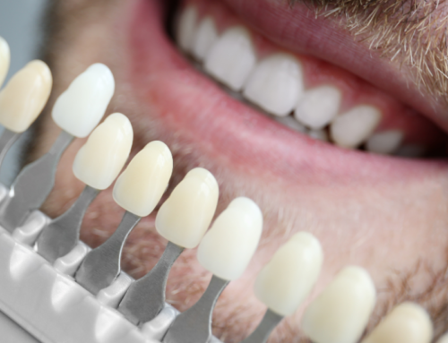 Microcarillas dentales: Qué son y cuándo usarlas