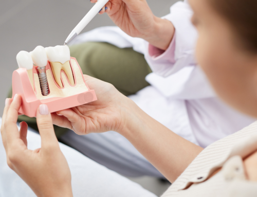 Implantes dentales: qué son y cuándo se necesitan.