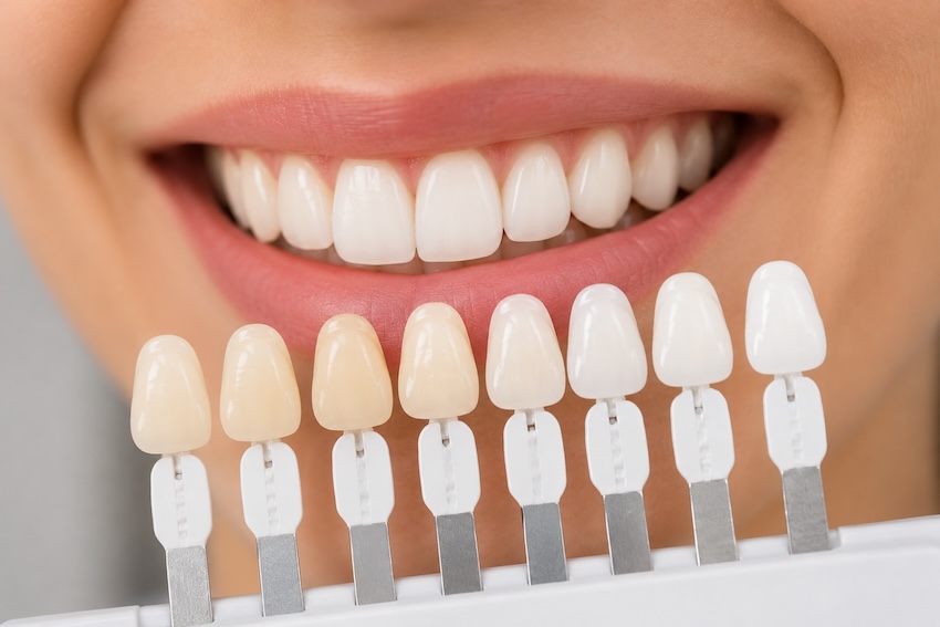 Carillas Dentales - Clínica dental Pilar Jarque Massamagrell
